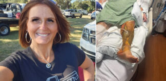 Bacteria ‘comecarne’ casi deja sin pierna a una mujer (Foto fuerte)