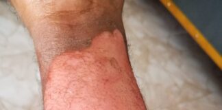 Hombre sufre quemaduras por vapor del radiador de un vehículo en SPM