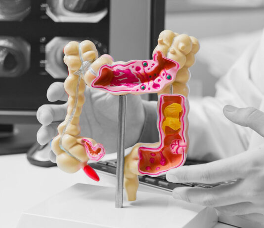 Muertes por cáncer colorrectal crecen entre este grupo de jóvenes