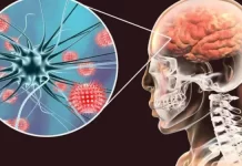 Salud reporta 50 casos sospechosos de meningitis en lo que va de año