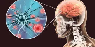 Salud reporta 50 casos sospechosos de meningitis en lo que va de año