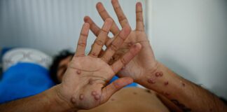 Salud Pública activa protocolo tras dos casos de viruela símica en San Cristóbal
